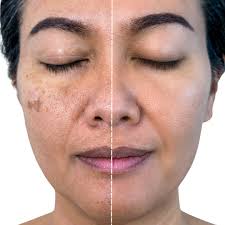 Microneedling treatment